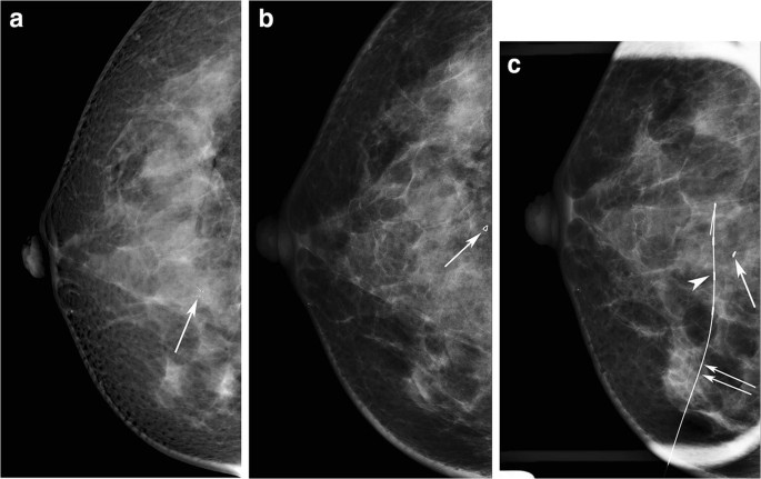 Clip migration after stereotactic vacuum-assisted breast biopsy with the  patient in the decubitus position | SpringerLink