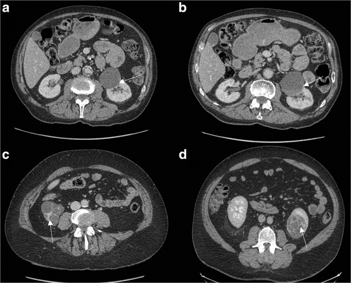 Complex Renal Cysts Bosniak Iif Interobserver Agreement Progression And Malignancy Rates Springerlink Complex Renal Cysts Bosniak Iif Interobserver Agreement Progression And Malignancy Rates Springerlink