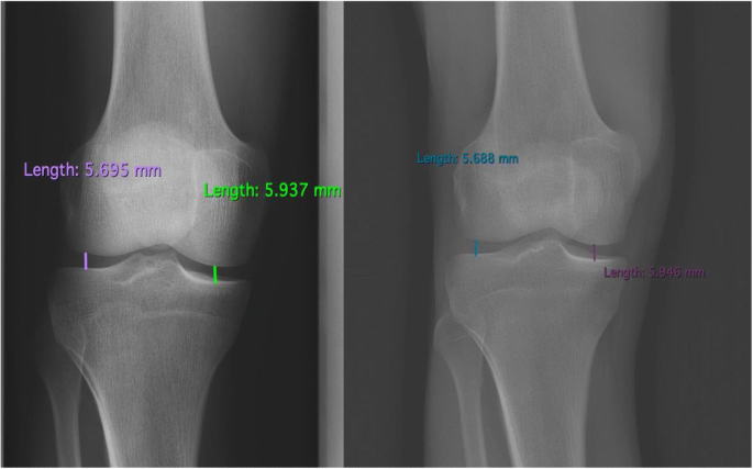Is The Eos Imaging System As Accurate As Conventional Radiography In Grading Osteoarthritis Of The Knee Springerlink