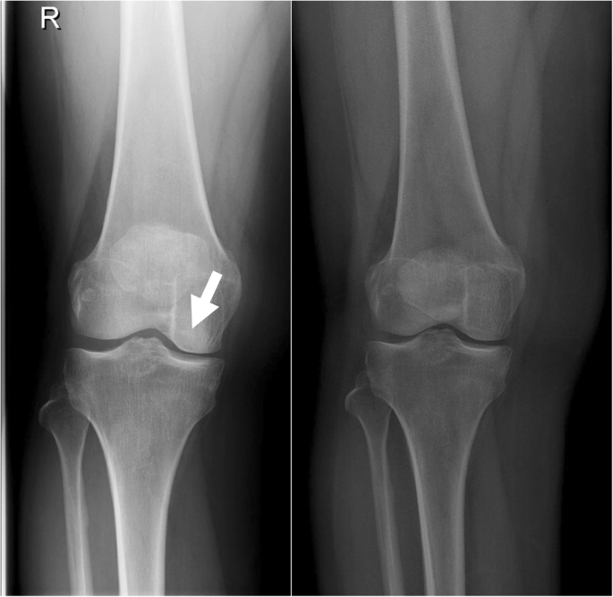 Is The Eos Imaging System As Accurate As Conventional Radiography In Grading Osteoarthritis Of The Knee Springerlink
