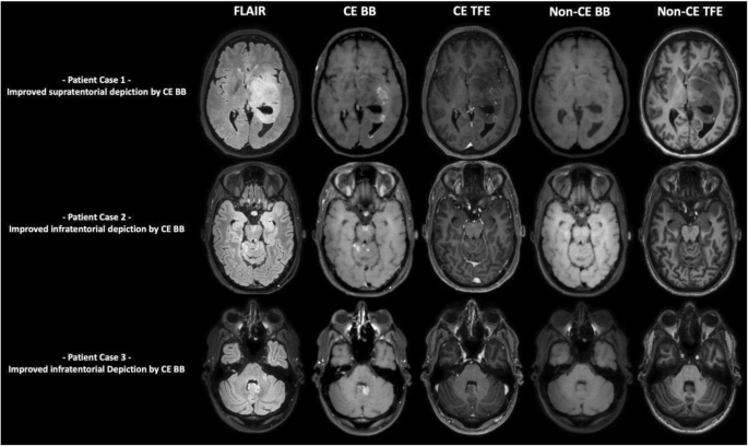 T1 weighted mri blood
