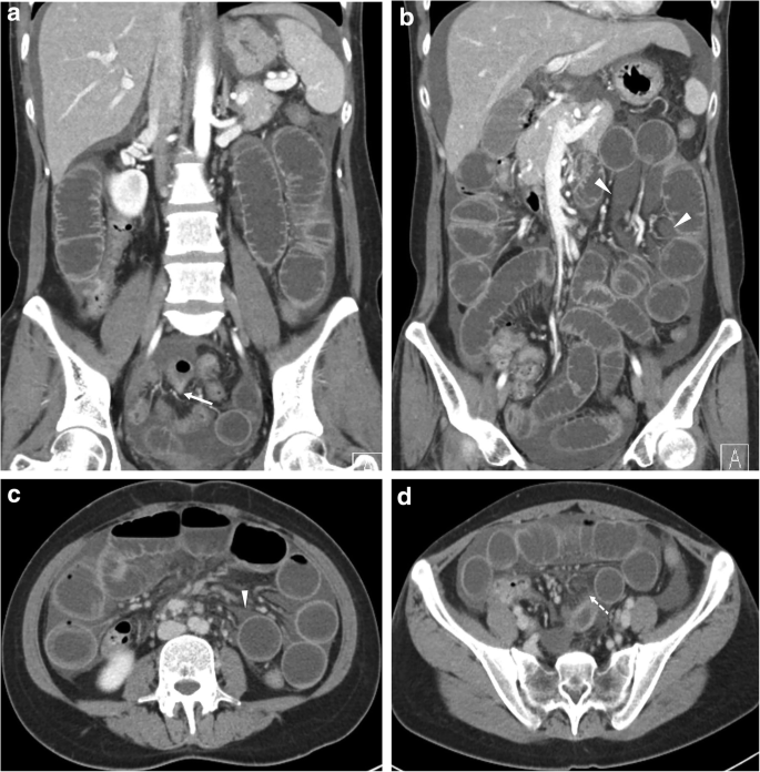 Non Strangulated Adhesive Small Bowel Obstruction Ct Findings Predicting Outcome Of Conservative Treatment Springerlink