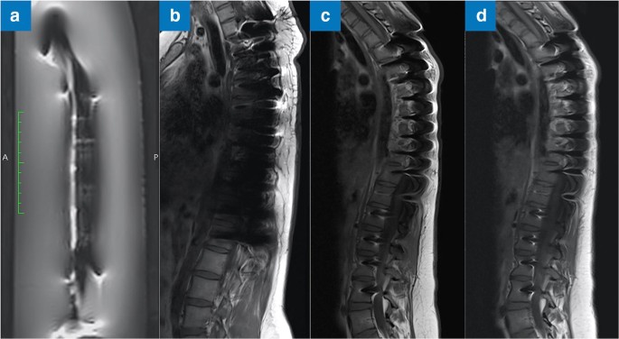 MRI following scoliosis surgery? An analysis of implant heating,  displacement, torque, and susceptibility artifacts | European Radiology