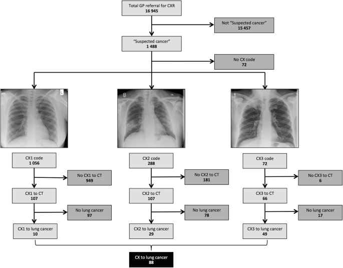 Chest X-ray in suspected lung cancer is harmful | SpringerLink