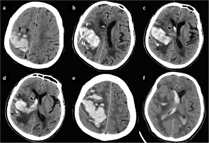 A model comprising the blend sign and black hole sign shows good  performance for predicting early intracerebral haemorrhage expansion: a  comprehensive evaluation of CT features | SpringerLink