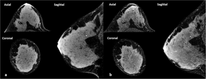 Comparison of background parenchymal enhancement (BPE) on contrast-enhanced  cone-beam breast CT (CE-CBBCT) and breast MRI | SpringerLink