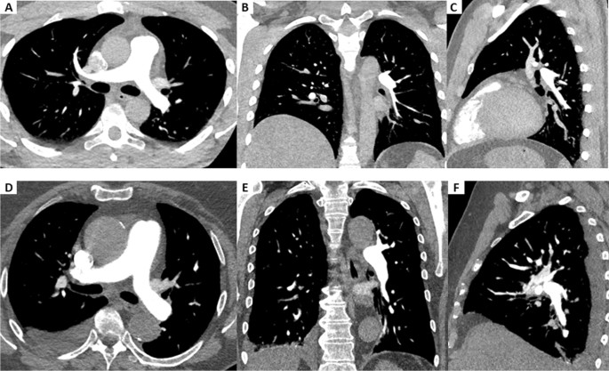 Bracco Creates Multi-Dose Compliant Contrast Medium for Point-of-Care Use  in the CT Suite