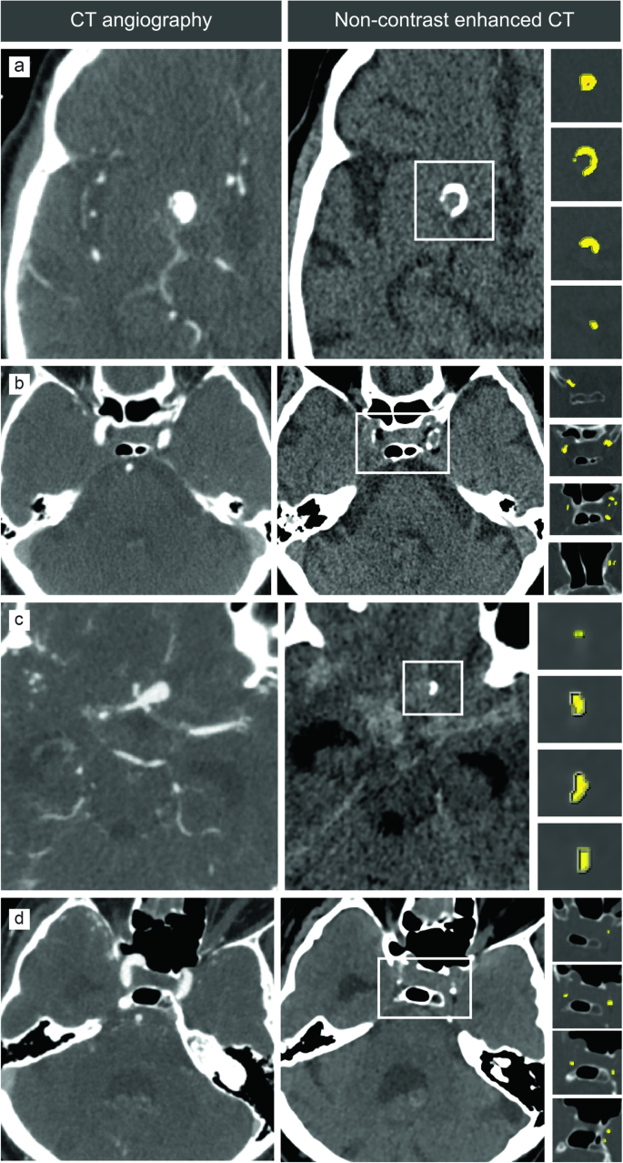 Calcification d'anévrysme intracrânien sur scanner (CT angio vs CT sans injection)