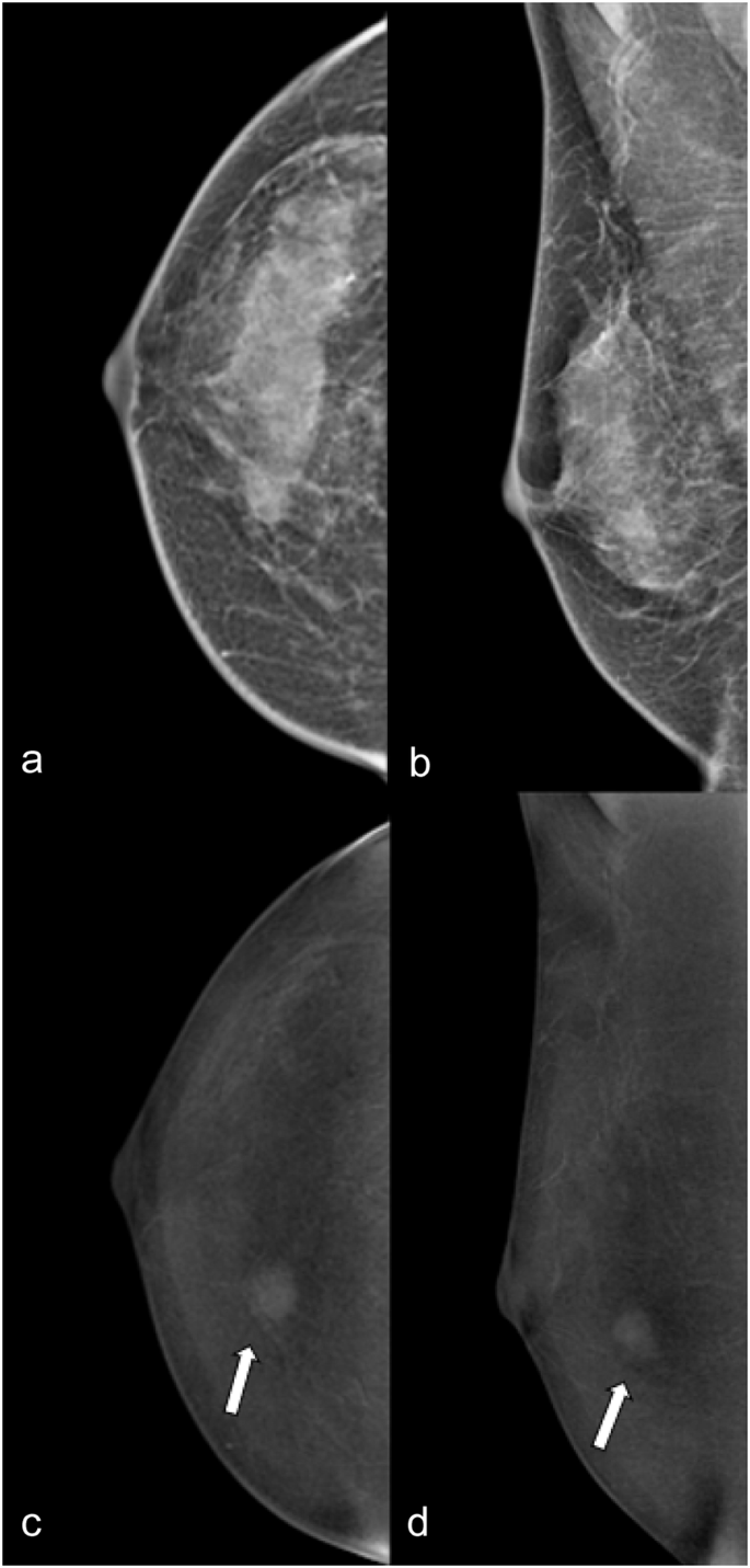 Inter-reader agreement of the BI-RADS CEM lexicon | European Radiology ...