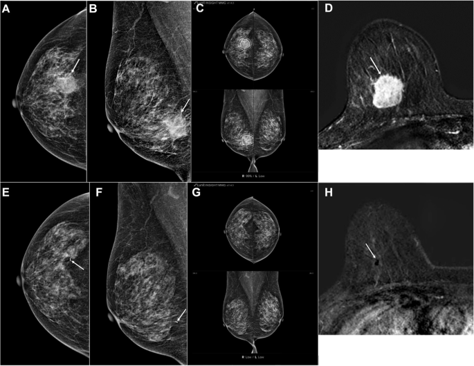 Digital mammography with AI-based computer-aided diagnosis to predict ...