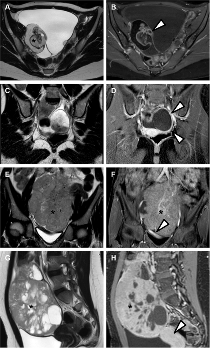 O Rads Example Mri MRI of pediatric ovarian masses: validation of the O-RADS framework ...