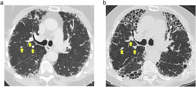 Progressive pulmonary fibrosis | European Radiology | Springer Nature Link