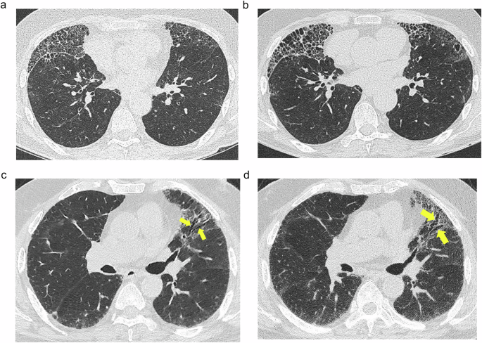 Progressive pulmonary fibrosis | European Radiology | Springer Nature Link