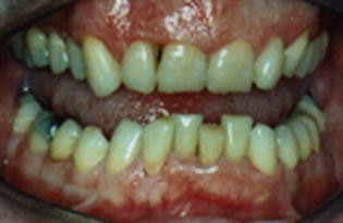 Kraniomandibuläre Dysfunktionen—eine Kontraindikation für  Schnarcherschienen? | SpringerLink