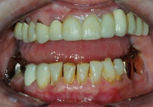 Kraniomandibuläre Dysfunktionen—eine Kontraindikation für  Schnarcherschienen? | SpringerLink
