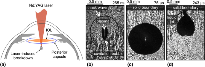 Photodisruption of a thin membrane near a solid boundary: an in vitro study  of laser capsulotomy | SpringerLink