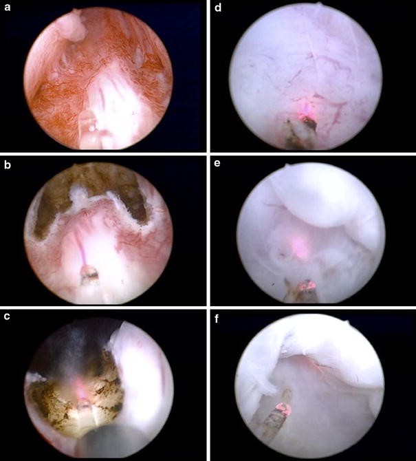 Thulium laser enucleation of the prostate (ThuLEP): transurethral  anatomical prostatectomy with laser support. Introduction of a novel  technique for the treatment of benign prostatic obstruction | SpringerLink