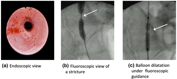 Minimally invasive management of ureteral strictures: a 5-year  retrospective study | SpringerLink