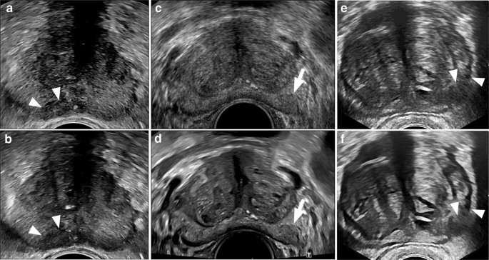 Advanced Ultrasound In The Diagnosis Of Prostate Cancer Springerlink