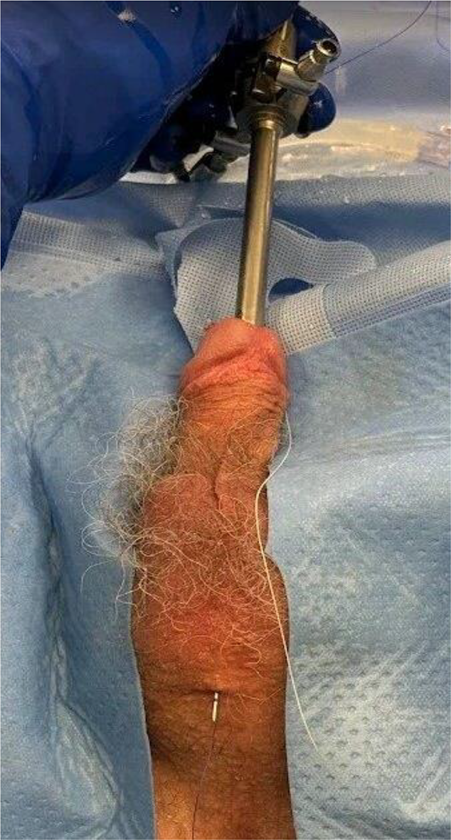 Transmeatal urethral surgery (TraMUS): technique and one-year outcomes ...