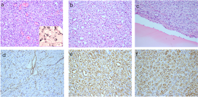 Fumarate hydratase-deficient renal cell carcinoma: high intratumoral ...