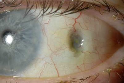 Schwarzer Fleck am Auge | Die Ophthalmologie