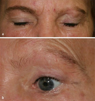 Einseitiger Augenbrauenverlust und wiederholte Botulinumtoxininjektionen |  SpringerLink