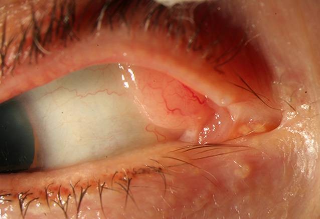 Lymphom Am Auge Springerlink Lymphom Am Auge Springerlink