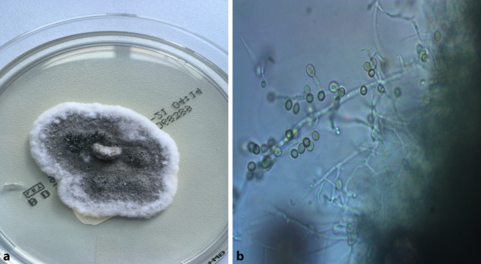Scedosporium apiospermum – Seltener Erreger einer mykotischen Keratitis |  SpringerLink