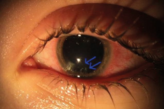 Verzögert auftretende Endophthalmitis nach perforierender Keratoplastik à  chaud bei Kontaktlinsen-assoziierter Akanthamöbenkeratitis | SpringerLink