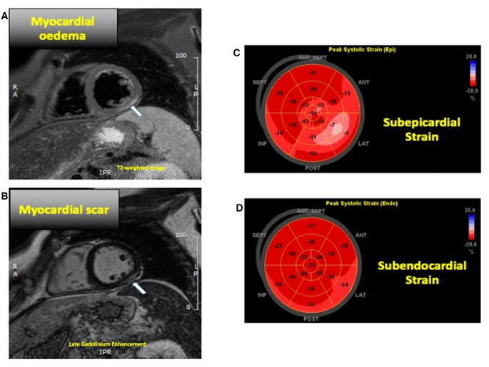 Myocardial strain assessed by feature tracking cardiac magnetic resonance  in patients with a variety of cardiovascular diseases – A comparison with  echocardiography