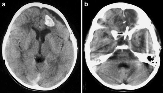 Intracavitary therapeutic options in the management of cystic  craniopharyngioma | SpringerLink