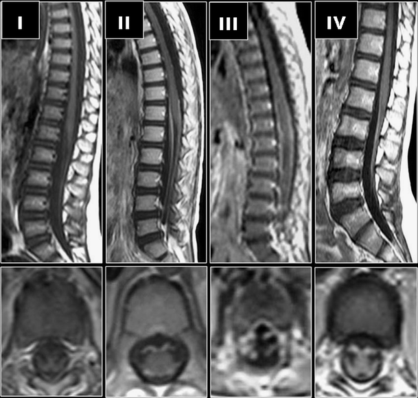 Magnetic Resonance Imaging Of Childhood Guillain Barre Syndrome Springerlink