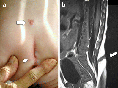 Spinal dermal sinus and pseudo-dermal sinus tracts: two different ...