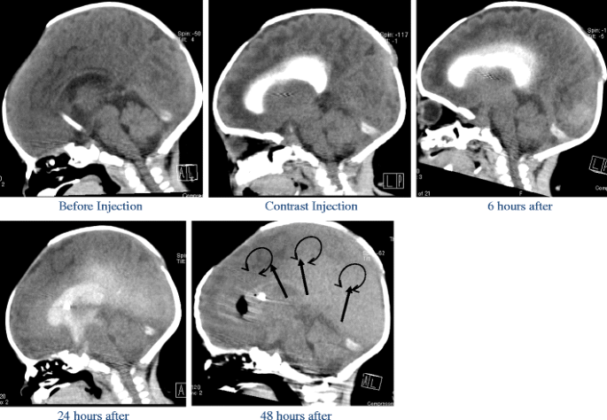 Hydrocephalus Hund
