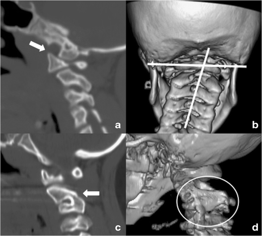 Rubinstein-Taybi syndrome  Radiology Reference Article
