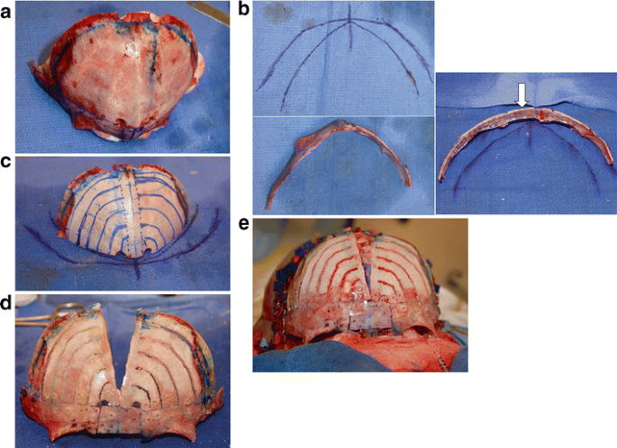 Parallel angulated frontal bone slat cuts for treatment of metopic  synostosis and other frontal skull deformities: the “cathedral dome  procedure” | SpringerLink