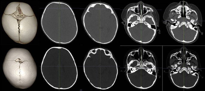 Three-dimensional analysis of cranial and facial asymmetry after helmet therapy for positional plagiocephaly | Child's Nervous System