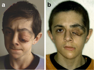 Sphenoid dysplasia in neurofibromatosis type 1: a new technique for repair  | SpringerLink