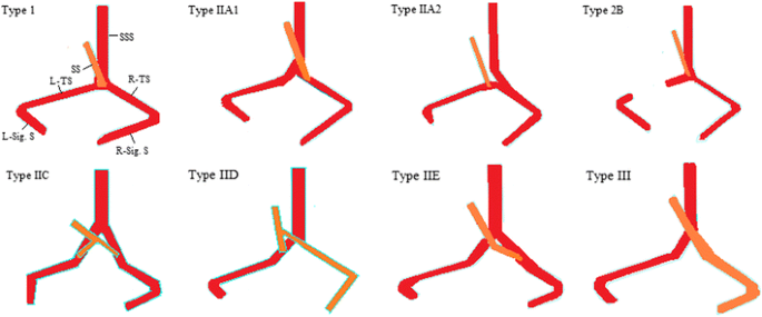 Evaluation Of Dural Venous Sinuses And Confluence Of Sinuses Via Mri Venography Anatomy Anatomic Variations And The Classification Of Variations Springerlink Evaluation Of Dural Venous Sinuses And Confluence Of Sinuses Via Mri Venography Anatomy Anatomic Variations And The Classification Of Variations Springerlink