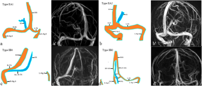 Evaluation Of Dural Venous Sinuses And Confluence Of Sinuses Via Mri Venography Anatomy Anatomic Variations And The Classification Of Variations Springerlink Evaluation Of Dural Venous Sinuses And Confluence Of Sinuses Via Mri Venography Anatomy Anatomic Variations And The Classification Of Variations Springerlink