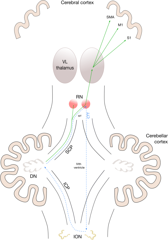Post Operative Paediatric Cerebellar Mutism Syndrome Time To Move Beyond Structural Mri Springerlink