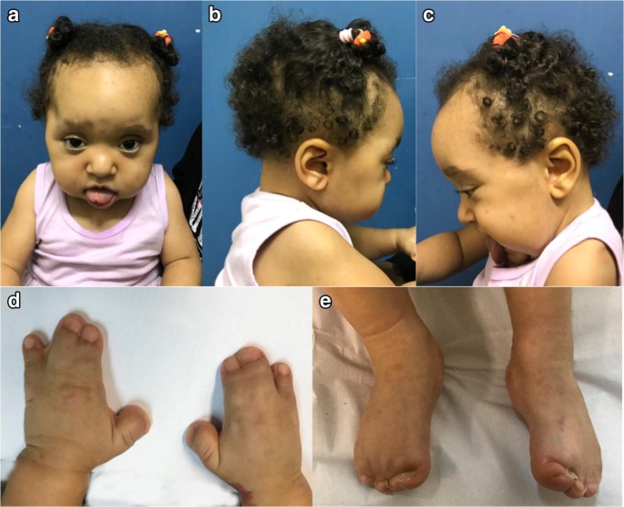 Apert syndrome without craniosynostosis | SpringerLink