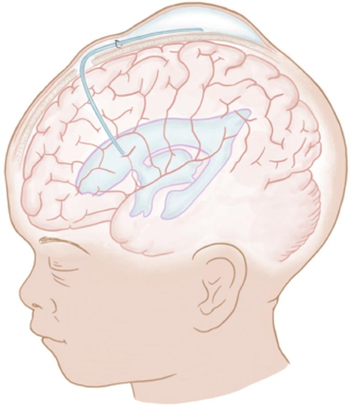 Intraventricular Hemorrhage And Posthemorrhagic Hydrocephalus In Preterm Infants Diagnosis Classification And Treatment Options Springerlink