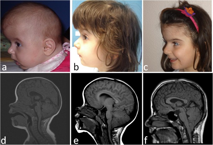 Chiari I Malformation In Defined Genetic Syndromes In Children Are There Common Pathways Springerlink