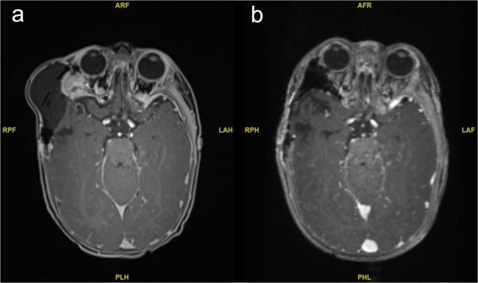 melanotic neuroectodermal tumour of infancy mnti Melanotic Neuroectodermal Tumour of Infancy: Clinical Courses and  Therapeutic OptionsA Review of Three Cases | Journal of Maxillofacial and  Oral Surgery