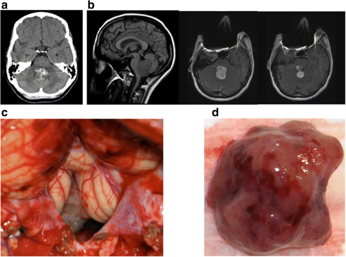 choroid plexus papilloma tumor