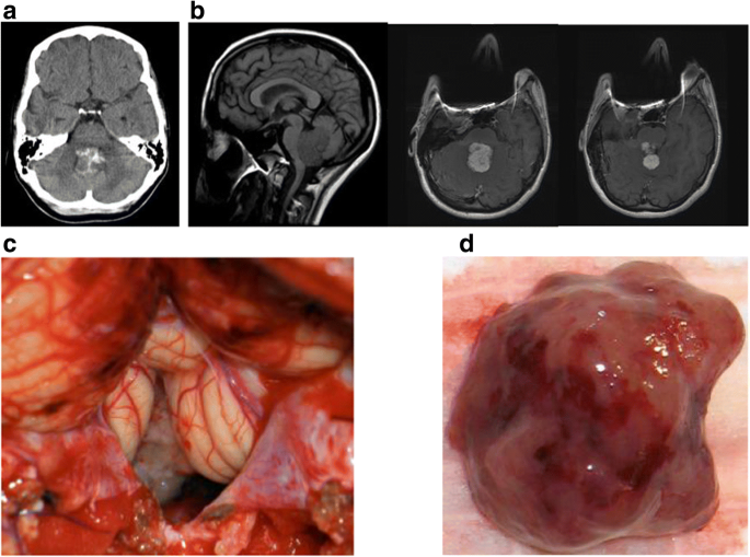 choroid papilloma tumor vaccino papilloma virus quadrivalente