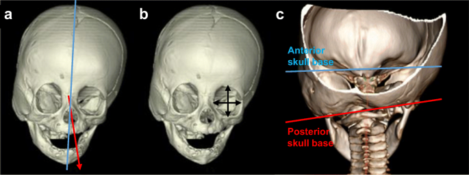 مشكلات العين مع التحام الدرز الإكليلي الأحادي عند الأطفال