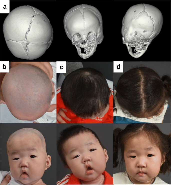ما هو التحام الدرز الإكليلي الأحادي؟